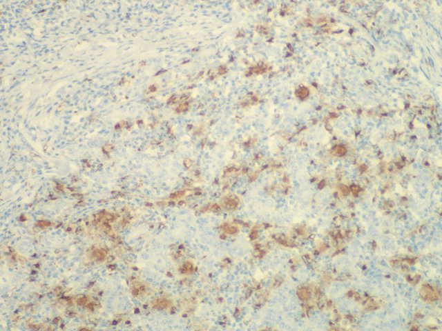 Figura 22. Inmunohistoqumica con CD68. Visin panormica que muestra positividad en clulas gigantes multinucleadas e histiocitos. 40x.
